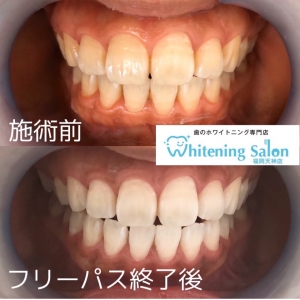 八重歯が可愛いのは日本だけ ホワイトニングサロン福岡天神店 格安３回4 980円 歯のホワイトニング専門店