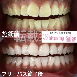 【ホワイトニング歯磨きの効果と危険性】