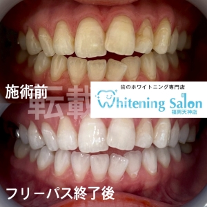 【歯の平均寿命】