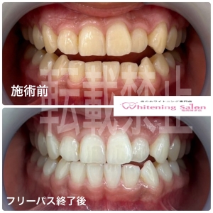 【ホワイトニングって歯に悪くないの？】