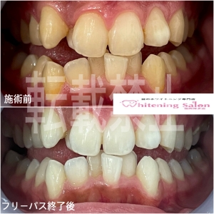 【歯石を放置するとどうなる？】