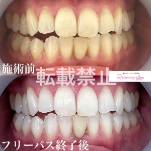 【今すぐお得にホワイトニング！】