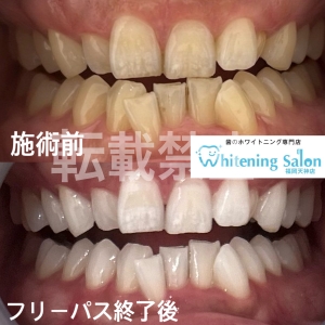 【根元の露出】