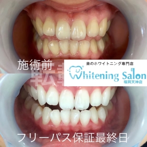 【視覚効果で歯を白く見せる】