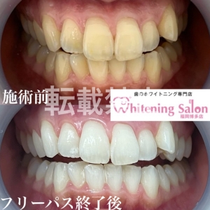 【ホワイトニング後の色戻り】