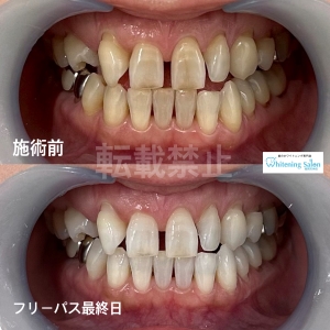 【知覚過敏かも！セルフチェック】