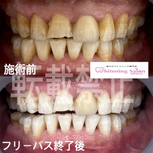 【歯のホワイトニングとクリーニングの違い】