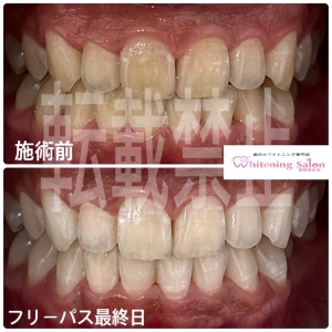 【ホワイトニングって歯に悪くないの？】