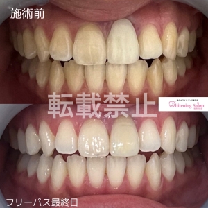 【口唇ヘルペスについて】