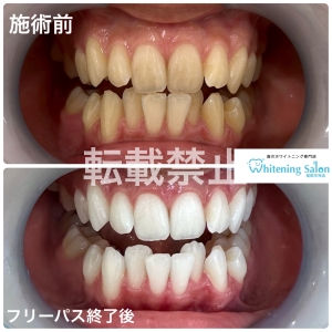 【歯の着色の種類について】