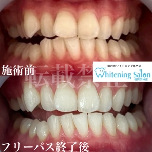 【フロスや歯間ブラシ使うと歯ぐきが強くなる！？】