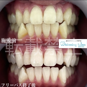 【綺麗な歯を維持しましょう】