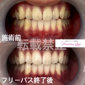 【実は知らない？知覚過敏の原因】