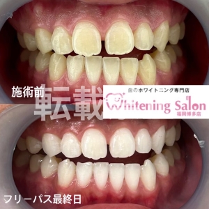 【フッ素の過剰摂取】