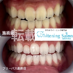 【エナメル質の重要性】