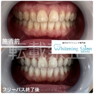 【市販のホワイトニング剤におけるデメリットとは？】