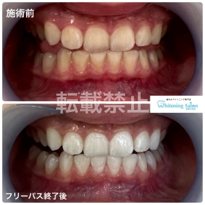 【エナメル質を傷つけないように☆】