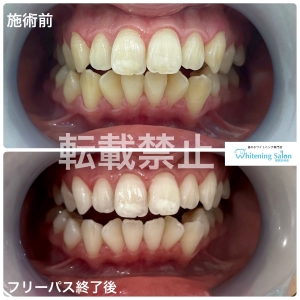 【ウォーターピックを知っていますか？？】