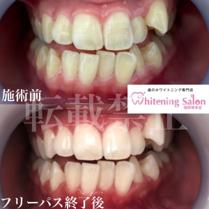 【健康な歯茎の条件】