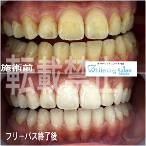 【オーラルケアに『ガム』は有効？？】