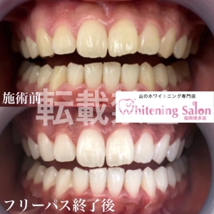 【手軽なホワイトニング】