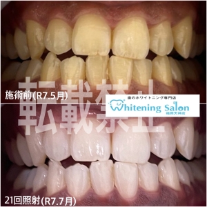 【ホワイトニングって歯に悪くないの？】