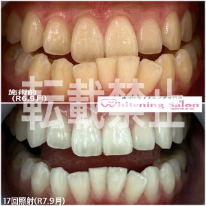 【ホワイトニングを始めよう！】