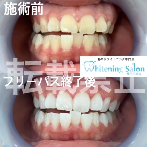 【今日からできる歯を強くする方法】