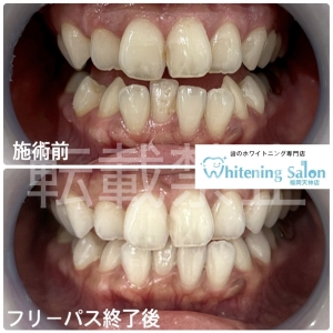 【自分に合う矯正】