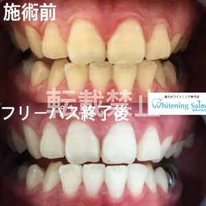 【歯茎が長くなった？】