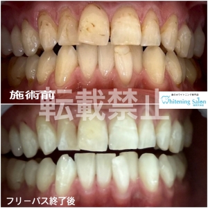 【歯磨きで対策！】