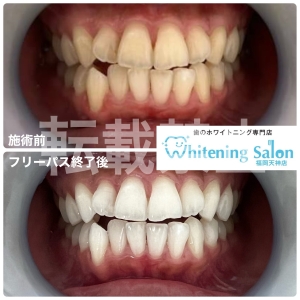 【ホワイトニングサロンの選び方】