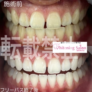 【ホワイトニングを始めよう！】