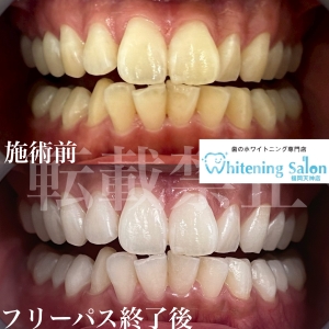 【歯列矯正に時間がかかる理由】