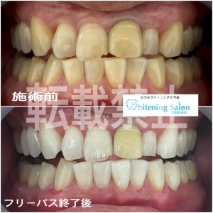 【食事制限なく歯を白くしたい！！】