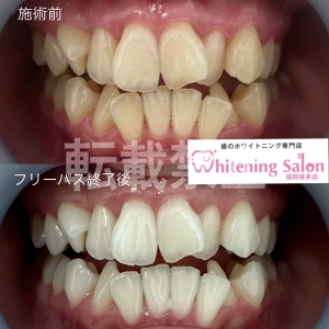 【食べ物が歯に挟まりやすい】