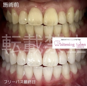 【ホワイトニングは体に害がある？！】