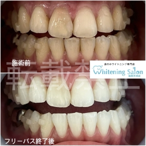 【セルフホワイトニングはなぜ安い！？】