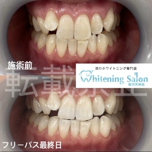 【ホワイトニングする人の割合】