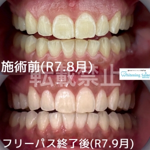 【歯磨きで対策】