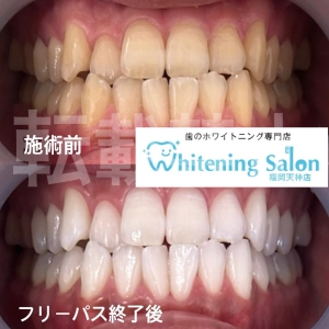 【健康な歯の条件】福岡天神/ホワイトニング