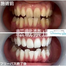 【歯磨き粉の適量】福岡天神/ホワイトニング