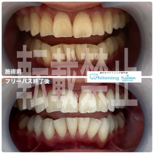 【強い歯の作り方】福岡天神/ホワイトニング