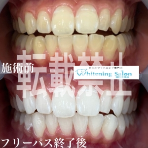 【歯を白くして５歳若返る】福岡天神/ホワイトニング