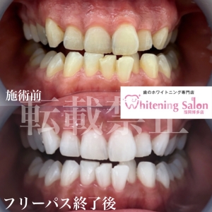 【ホワイトスポット】福岡/ホワイトニング