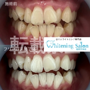 【ホワイトニングサロンの選び方】福岡天神/ホワイトニング
