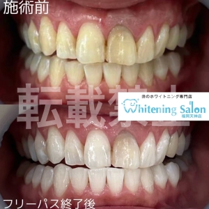 【適切なケア】福岡天神/ホワイトニング