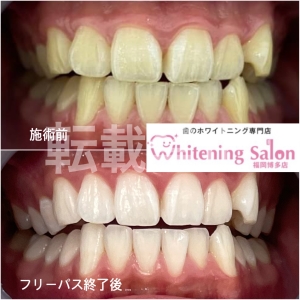 【大事なイベント前に】福岡博多/ホワイトニング