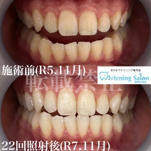 【歯ぐき由来の痛み】福岡天神/ホワイトニング