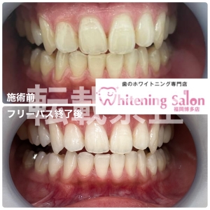 【歯茎の腫れ】福岡博多/ホワイトニング